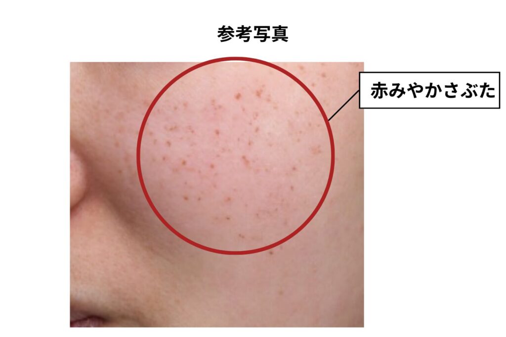 赤みやかさぶた