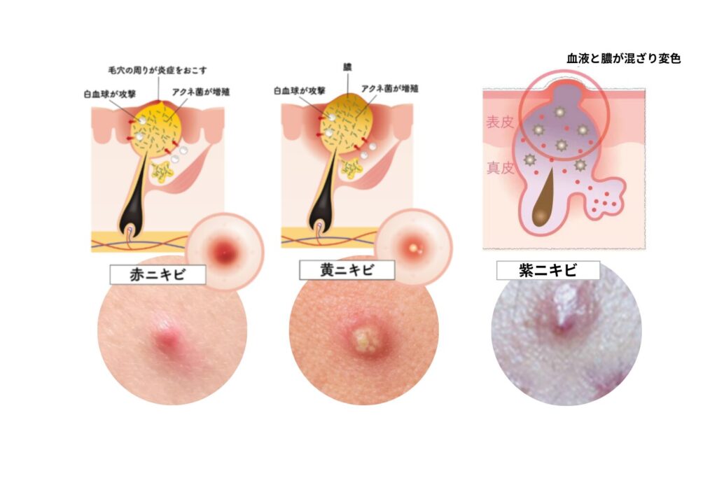 赤ニキビ・黄ニキビとの違い