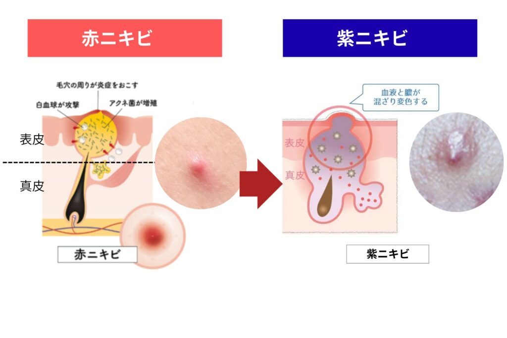 紫ニキビは自然に治りにくい状態