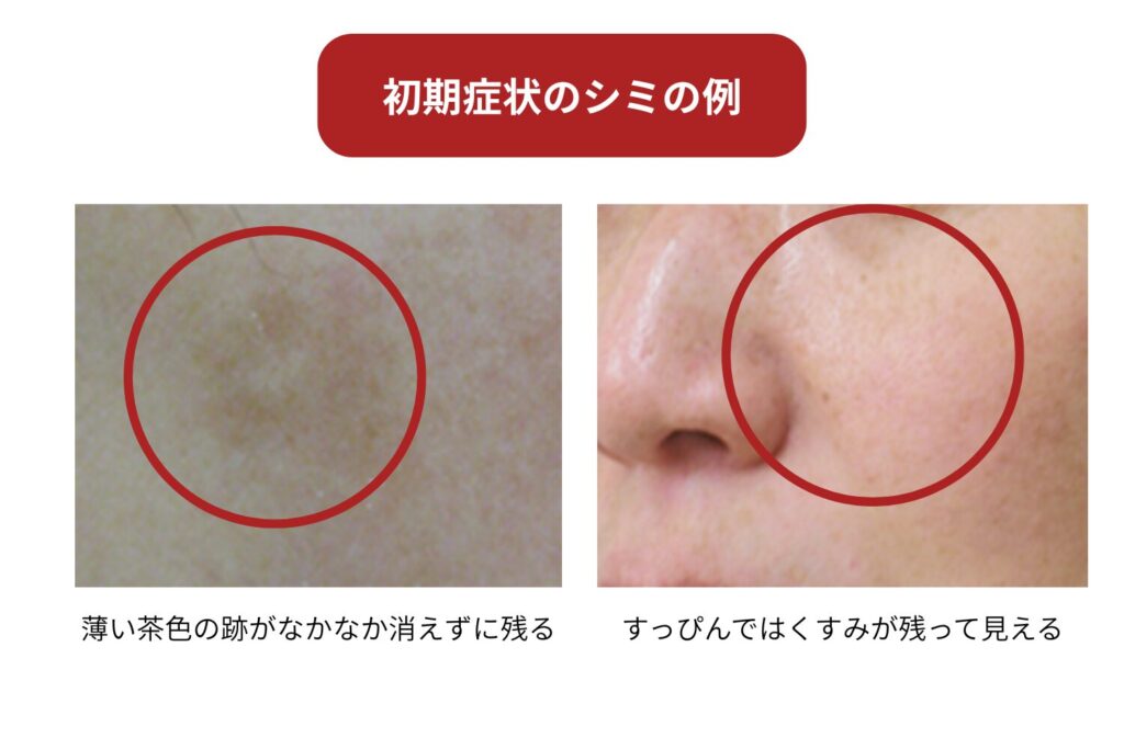 うっすらした変化を見逃さないことが大切