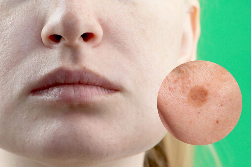 頬のシミ原因と消す方法は？種類別の見分け方と治療選び