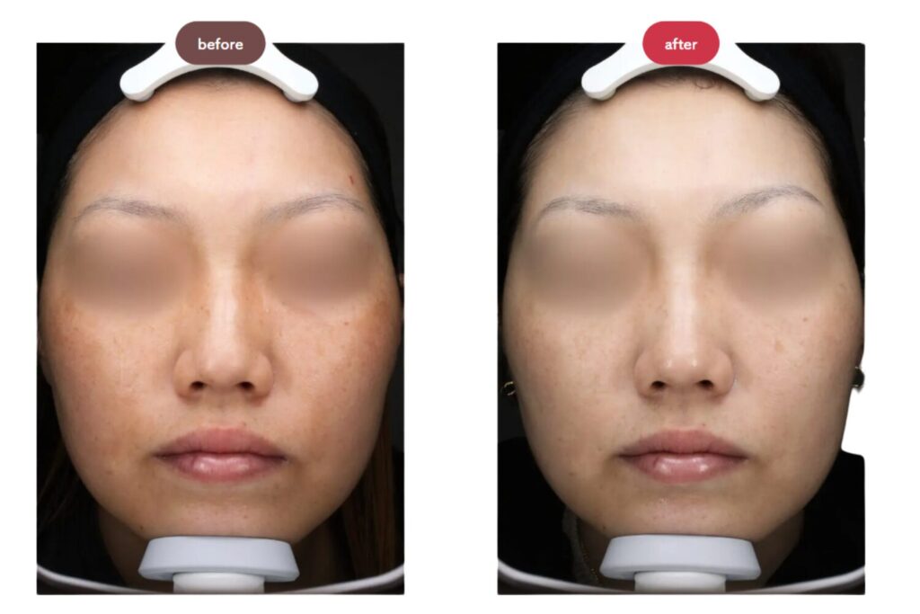 3回〜5回の継続治療で期待できる変化