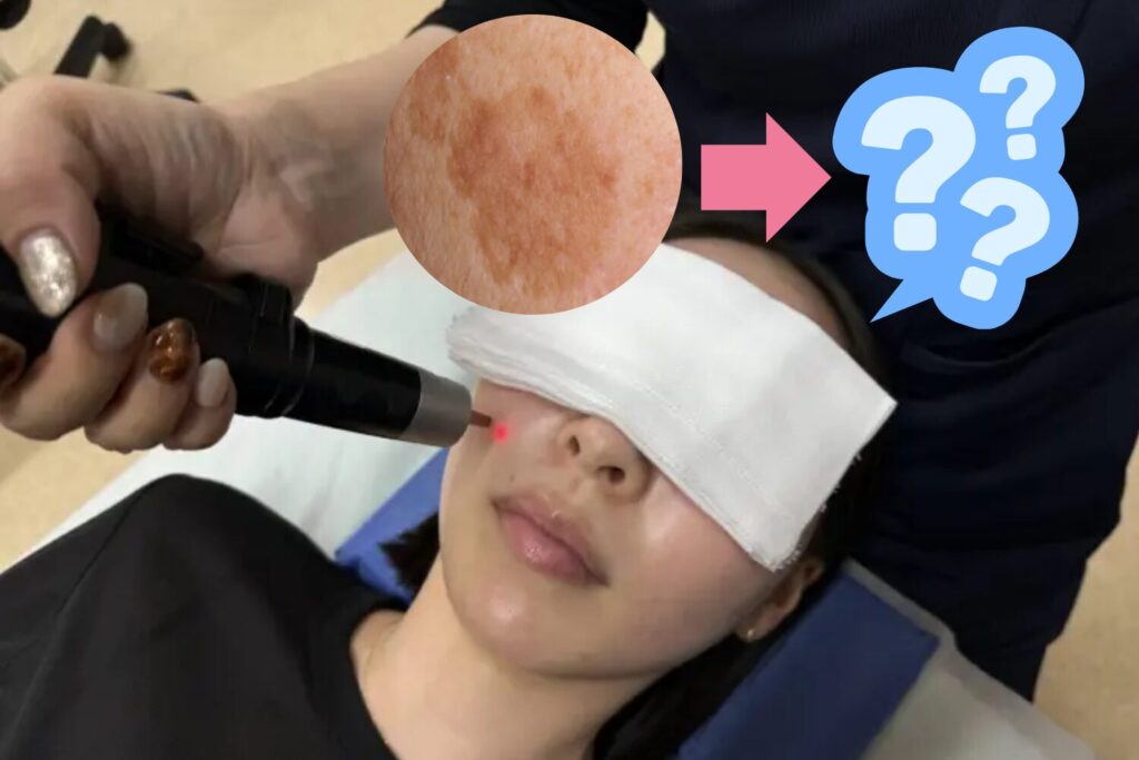 シミ取りピコレーザーの経過を解説！色素沈着と回復期間の全て