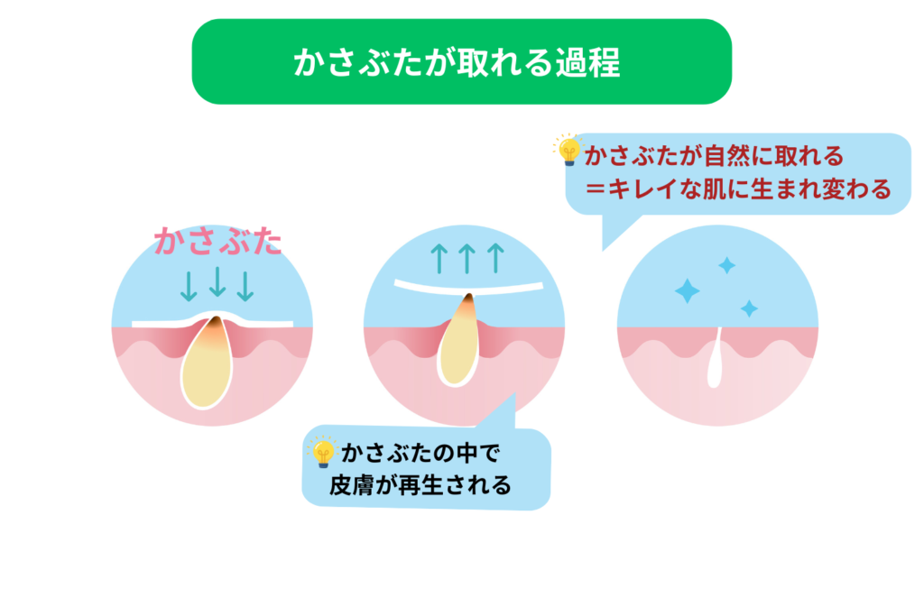 ニキビのかさぶたは触らず自然に治す