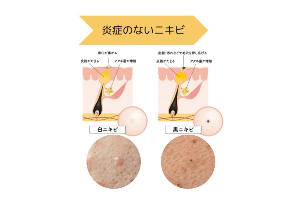 白・黒ニキビ