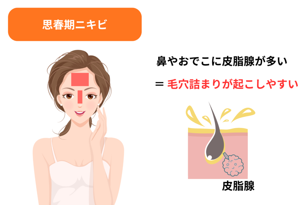 皮脂分泌が多い額と鼻にできやすい