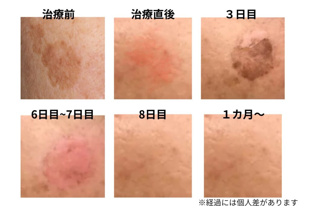 施術直後から1か月後まで段階的に変化する