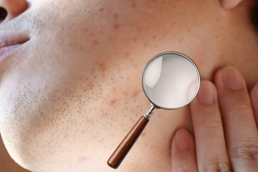 首ニキビの主な原因を整理する