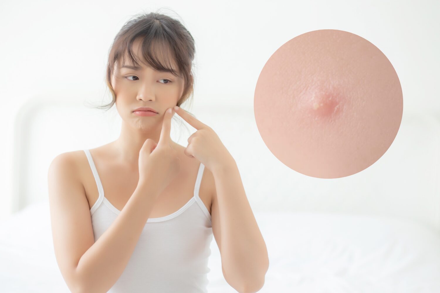 ニキビのしこりは治る?粉瘤との違いと悪化させないケア方法