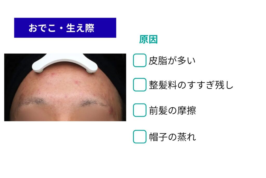 おでこ・生え際