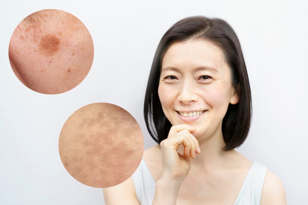 50代の正しいシミ取り方法とシミが増えたり濃くなる理由とは？