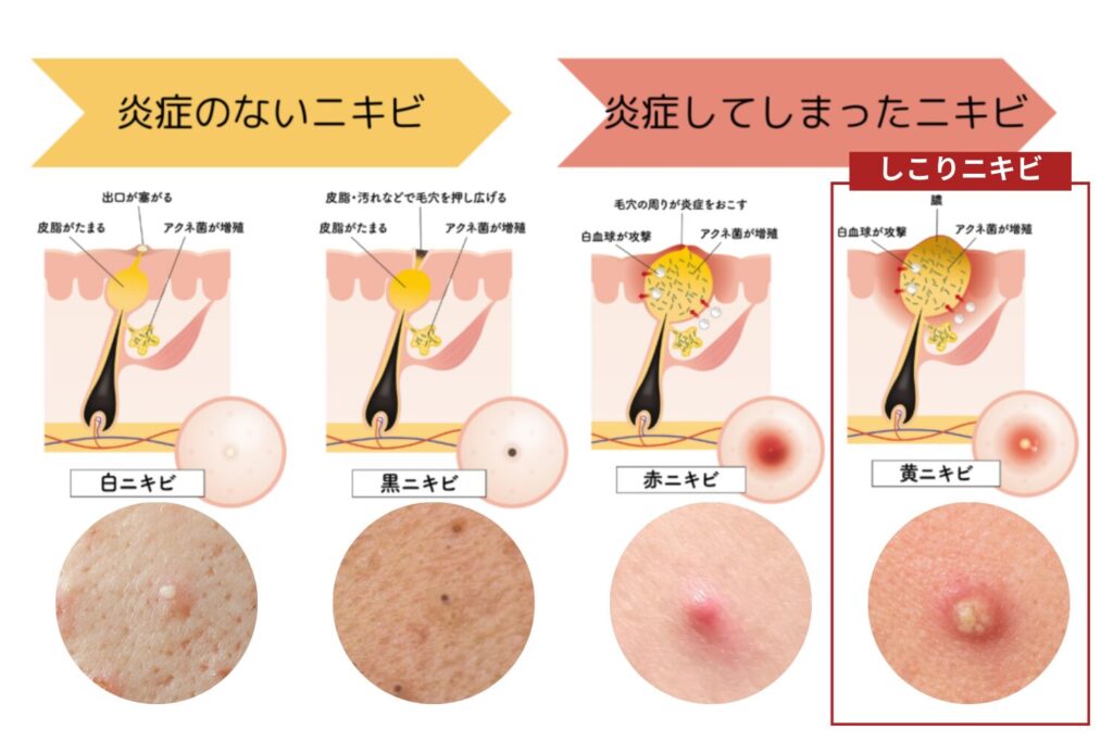 毛穴詰まりと深部炎症