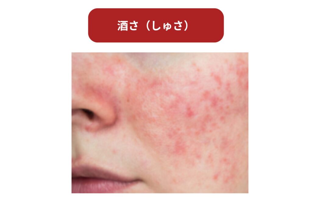 毛細血管拡張症や酒さ