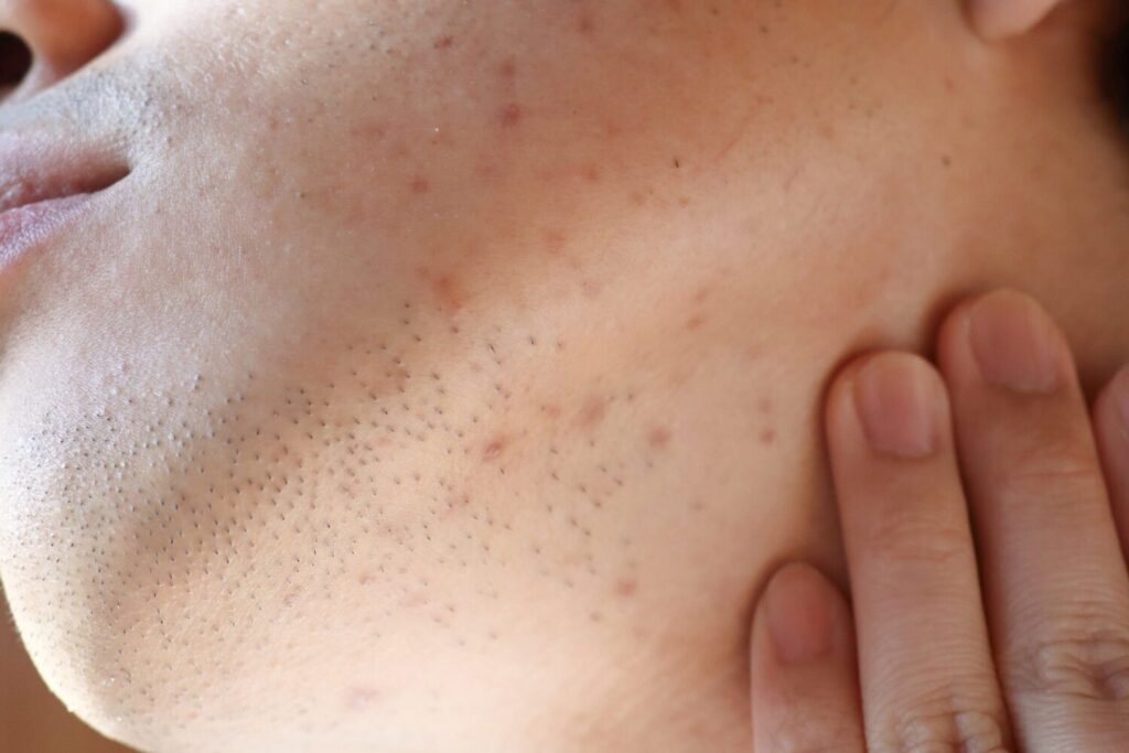 ニキビが首にできた時に知っておきたい原因と早く治すためのケア方法