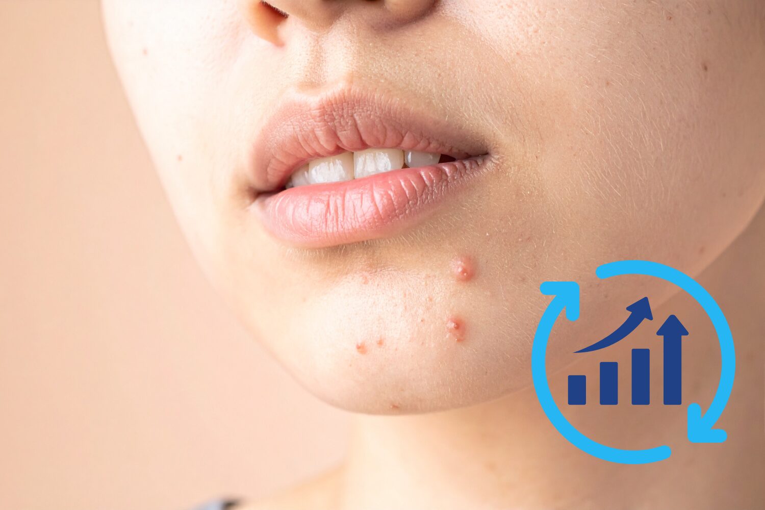 口周りニキビが治らない理由と改善のコツ