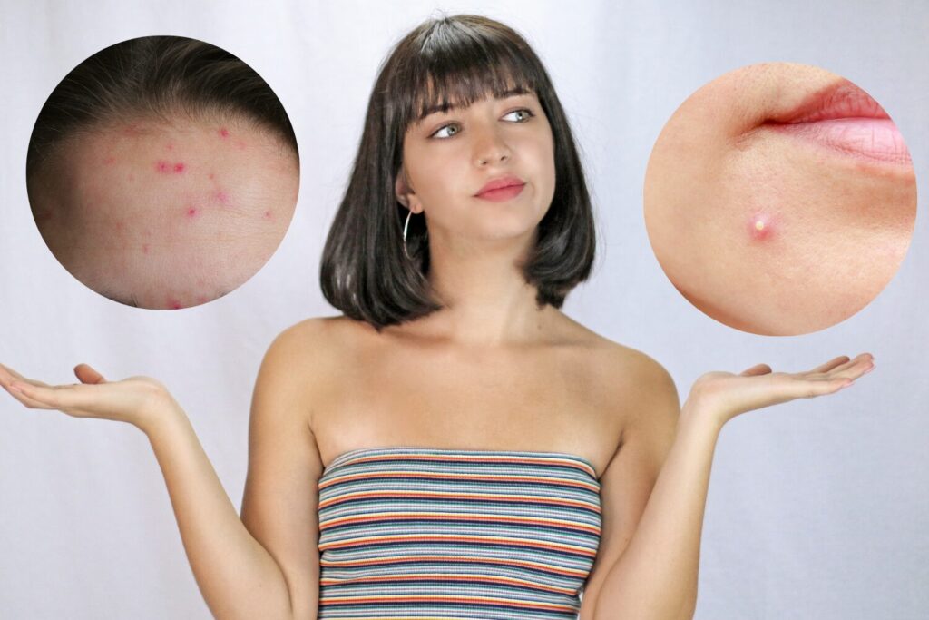 ニキビと吹き出物の違い|原因・正しい対処を徹底解説