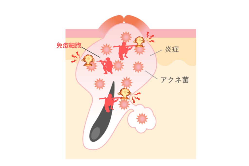 炎症の長期化と免疫反応