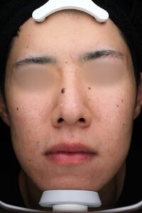 ニキビアフター