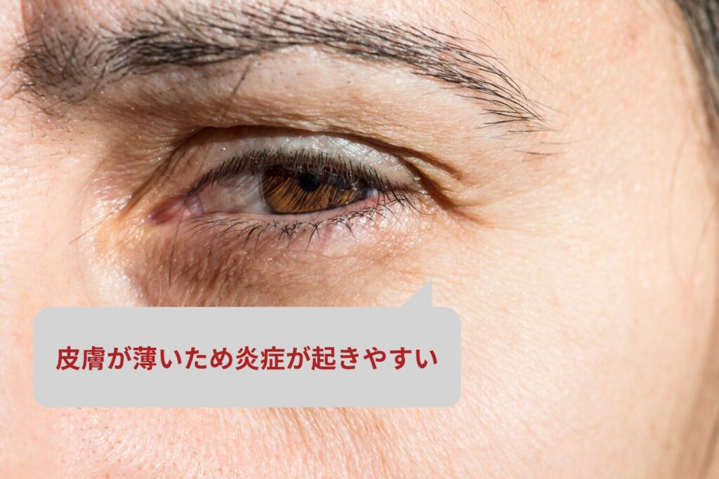 目の下はニキビができやすく治りにくい部位