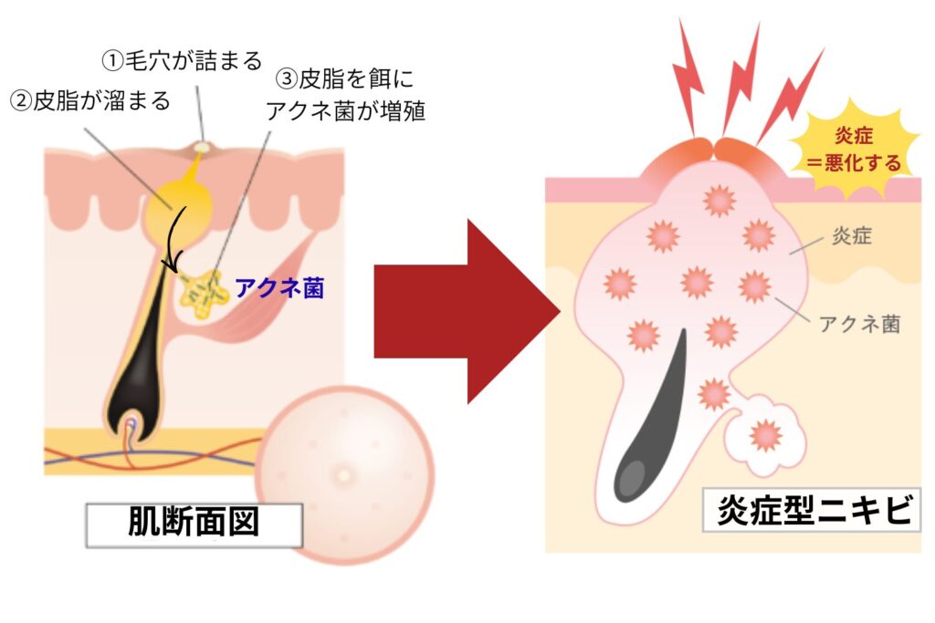 常在菌が増えると炎症が進む仕組み