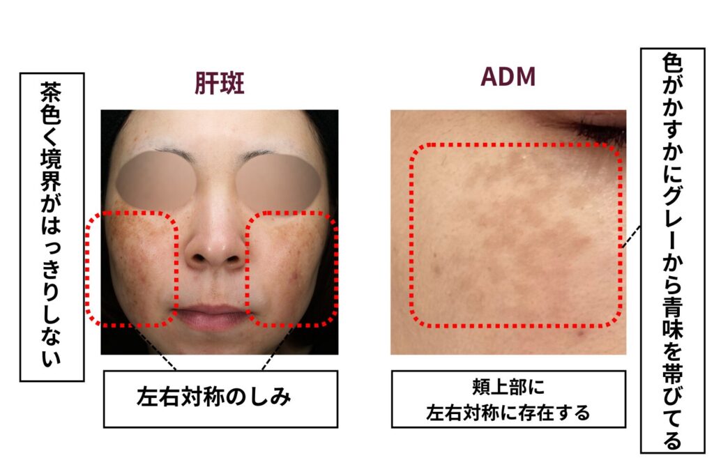 注意が必要なシミ