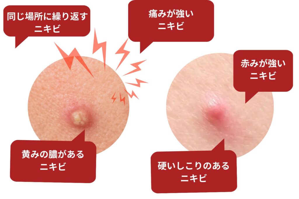 ニキビ跡を残しやすいサイン