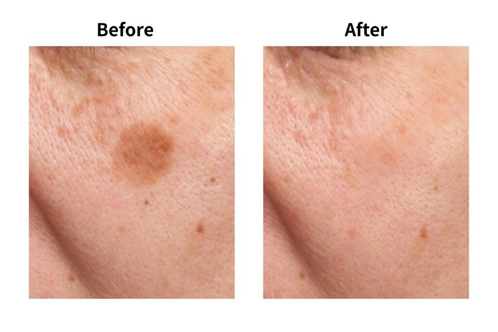 シミ取りキャンペーン