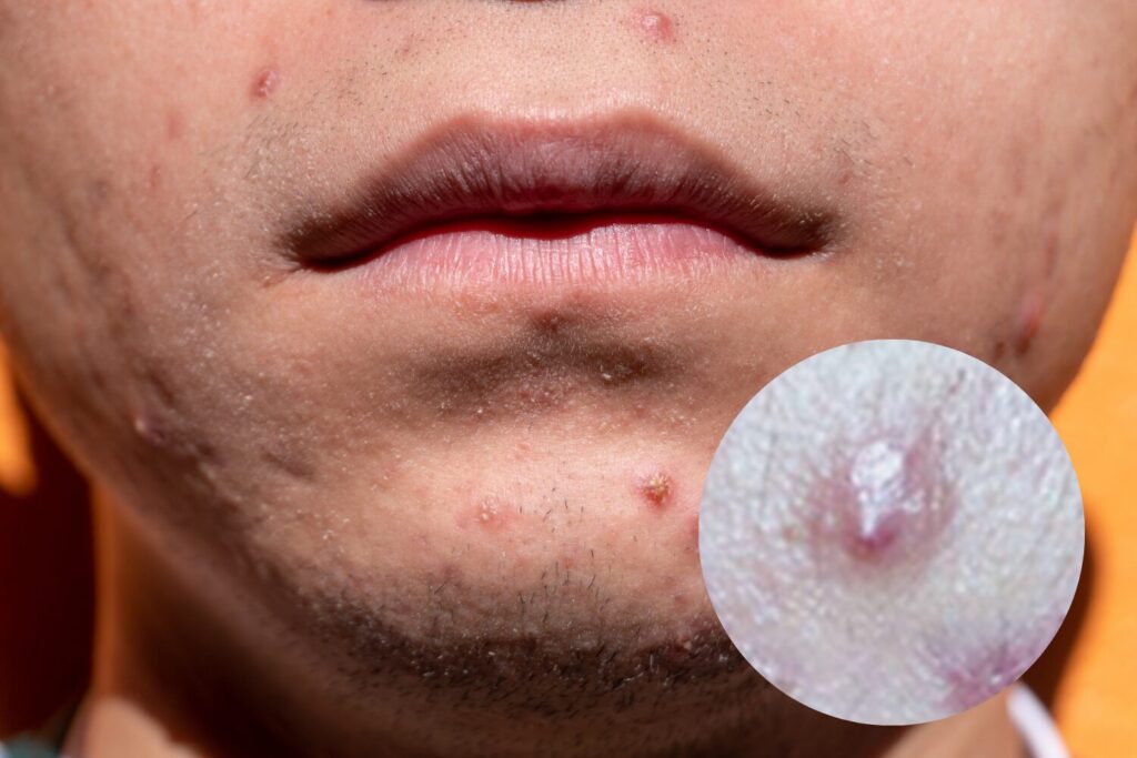 紫ニキビは自力で治る？原因から治療・予防まで完全解説