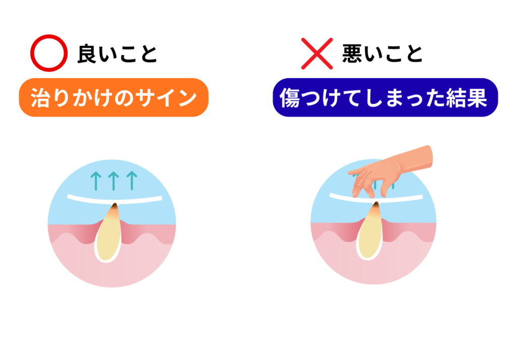 かさぶたができる2つの理由