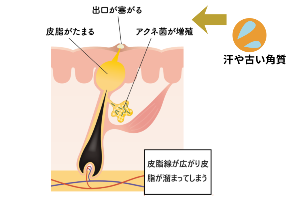 古い角質と皮脂が詰まるメカニズム