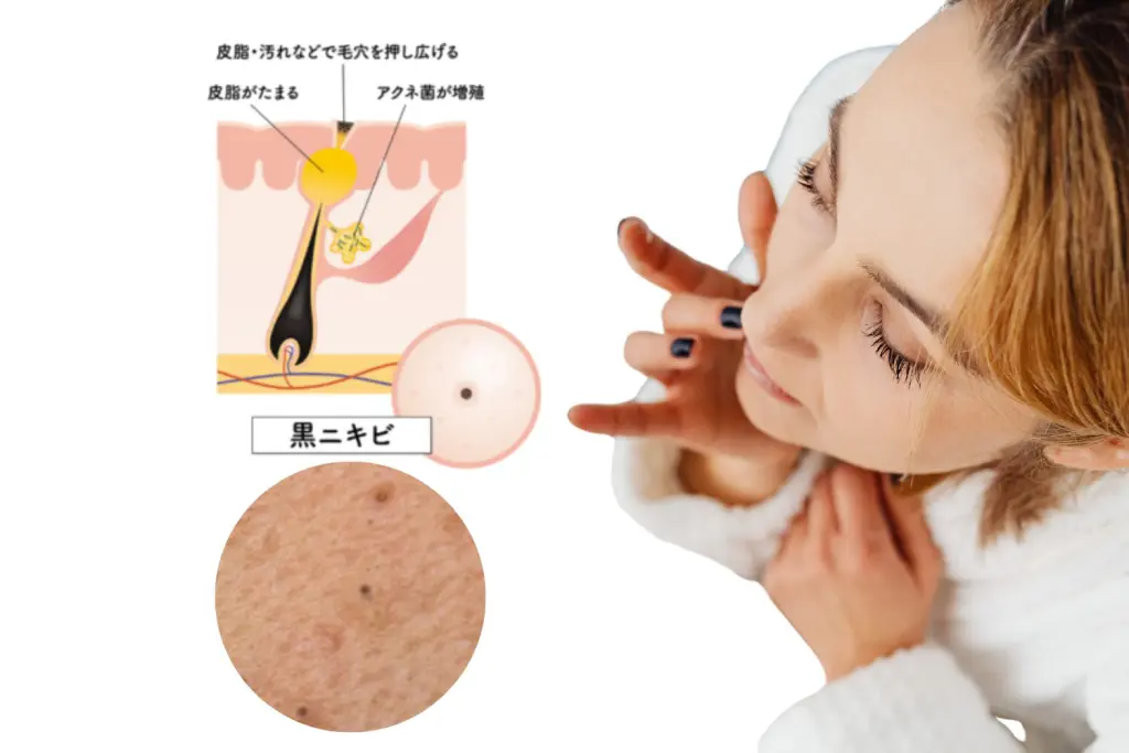 ニキビが黒い原因とは?黒ニキビの正体と正しい対処法
