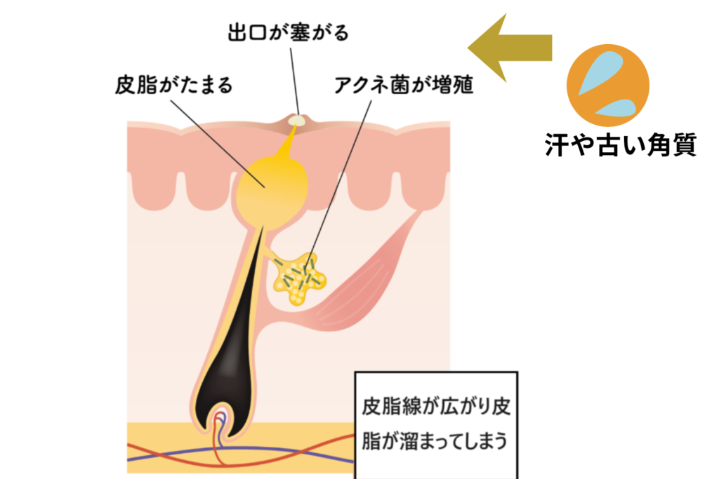 古い角質と皮脂が詰まるメカニズム