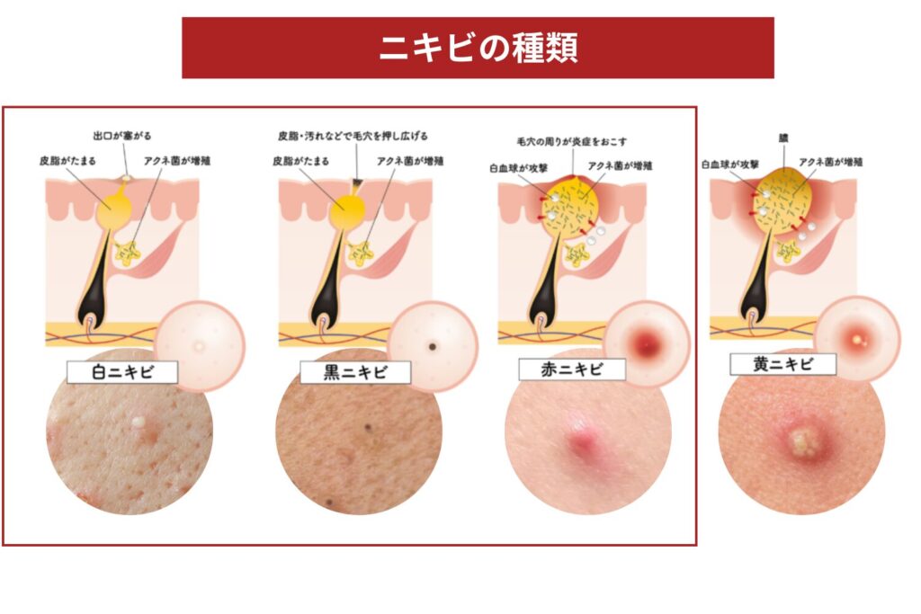市販薬が向くケースと注意点