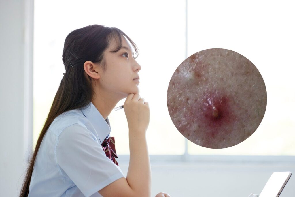 思春期ニキビの対策！原因・予防・皮膚科治療の流れ