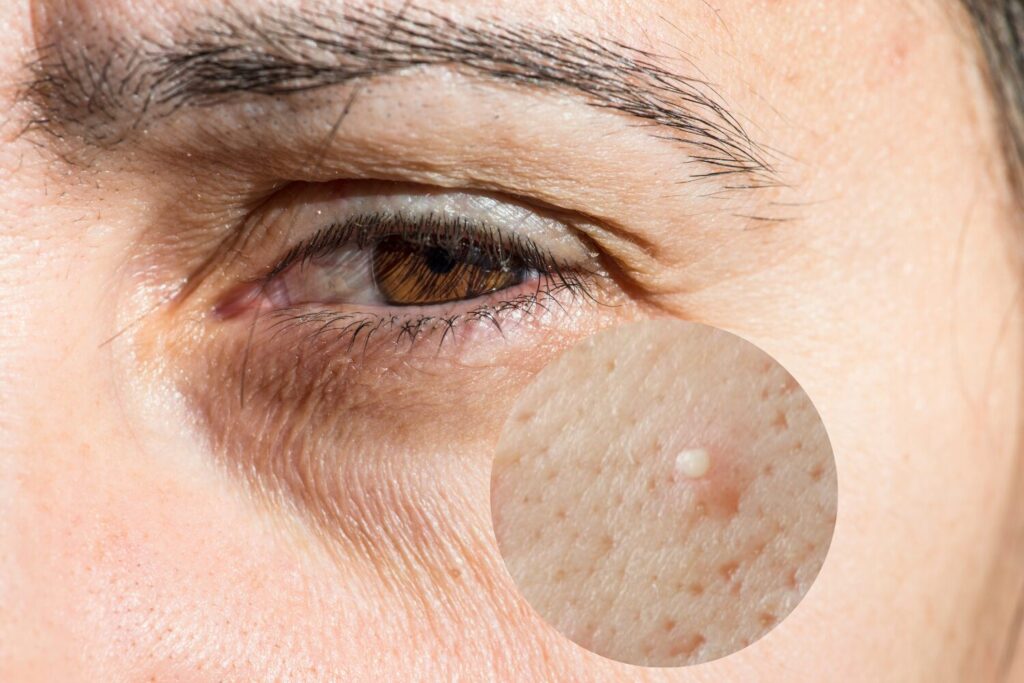 目の下のニキビの原因とは？間違えやすい症状も整理