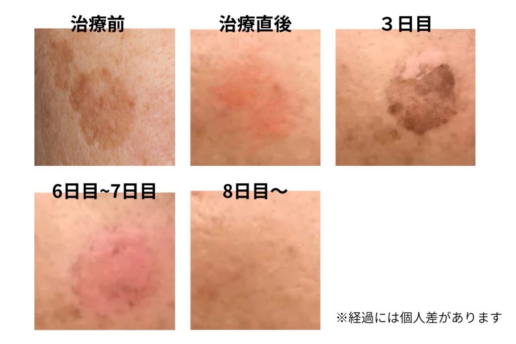 施術直後から1か月後まで段階的に変化する