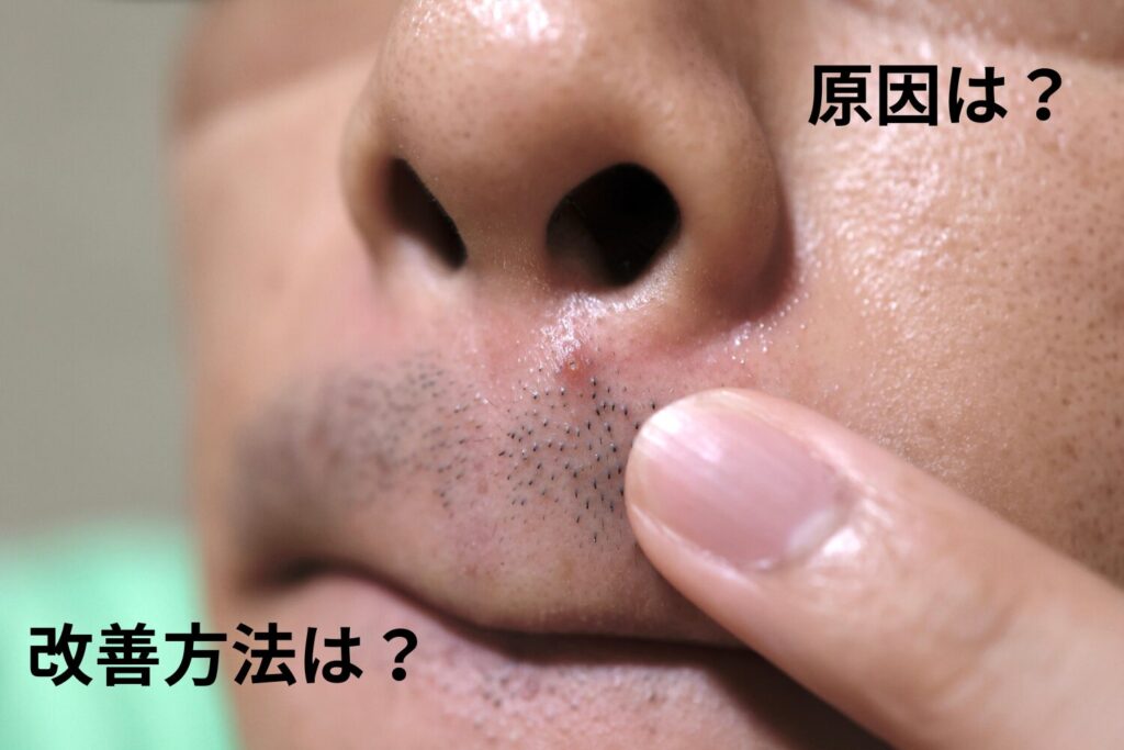 鼻の下ニキビの原因は?早期改善と予防の完全ガイド
