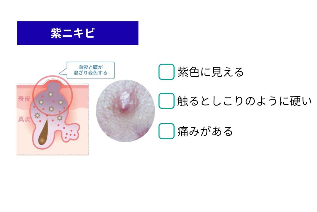 紫ニキビの定義と特徴