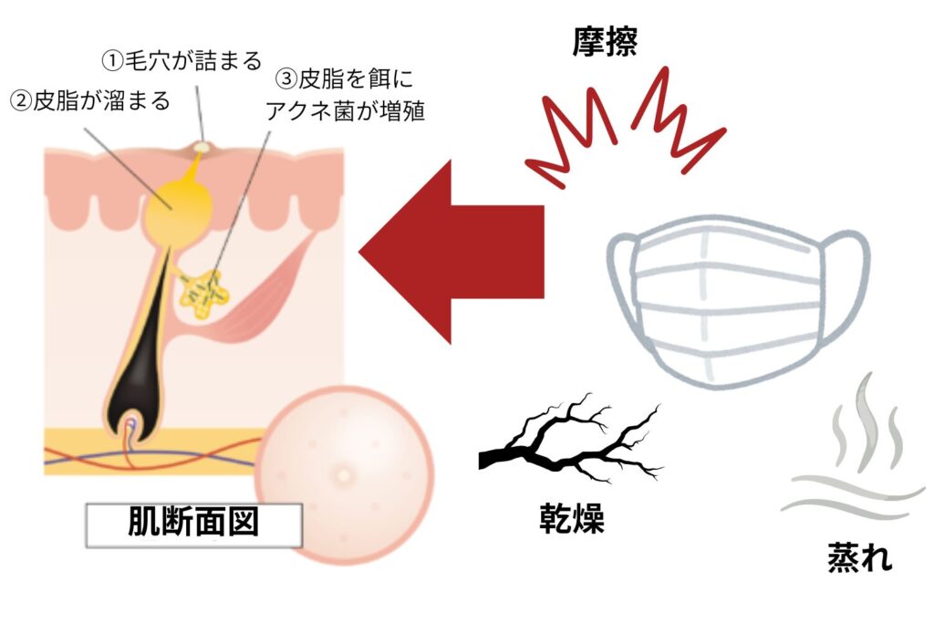 マスク着用がニキビを招く主な理由