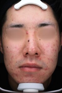 ニキビビフォー