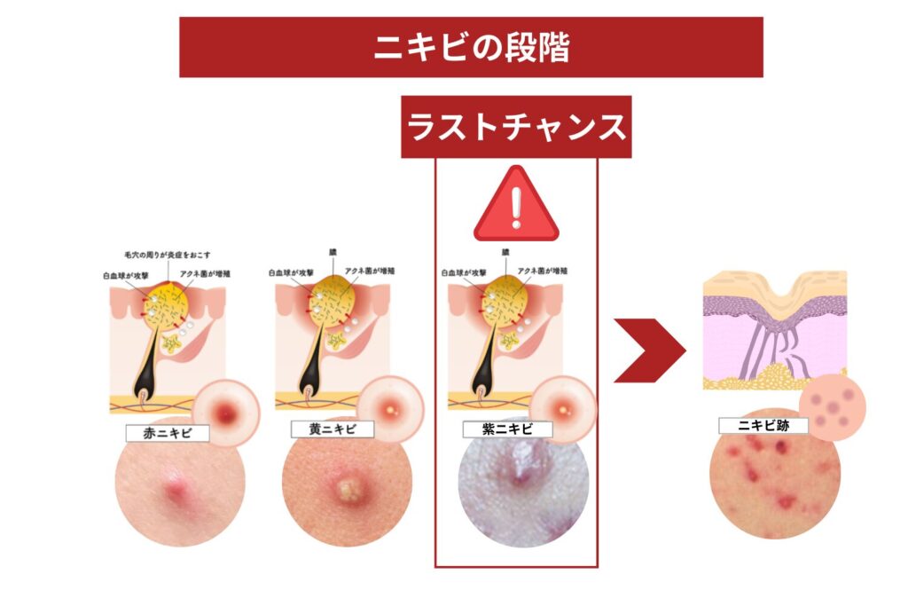 紫ニキビは早期対応が必要な重症ニキビ