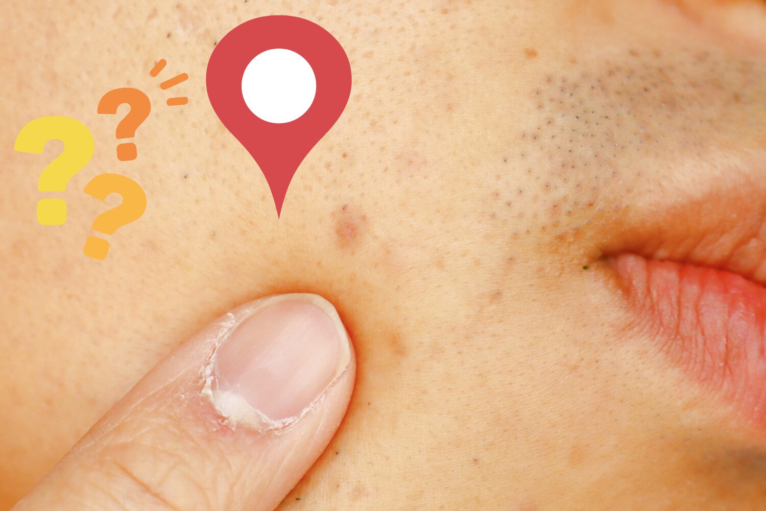 男性のニキビは場所で原因が違う|部位別対策まとめ