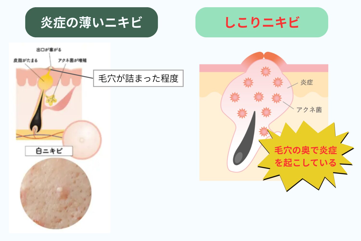 ニキビのしこりは治る?粉瘤との違いと悪化させないケア方法 - ハートライフクリニック(静岡県浜松市の美容皮膚科・美容外科)
