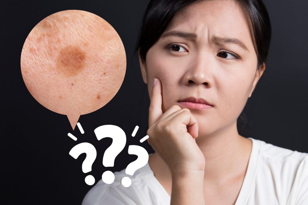 シミ取りのデメリットとは?レーザー治療前に知るべき注意点