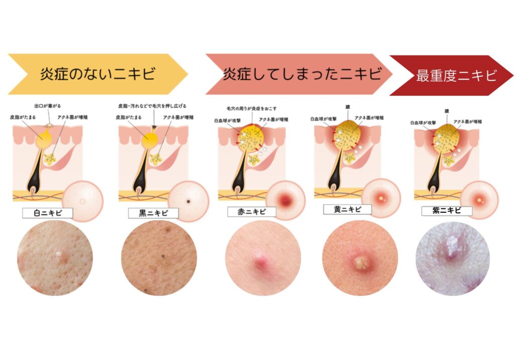 紫ニキビとは何か？