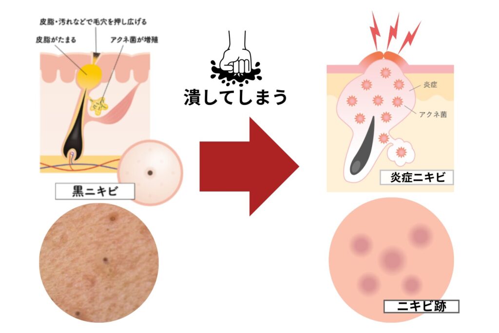 自分で押し出すリスク