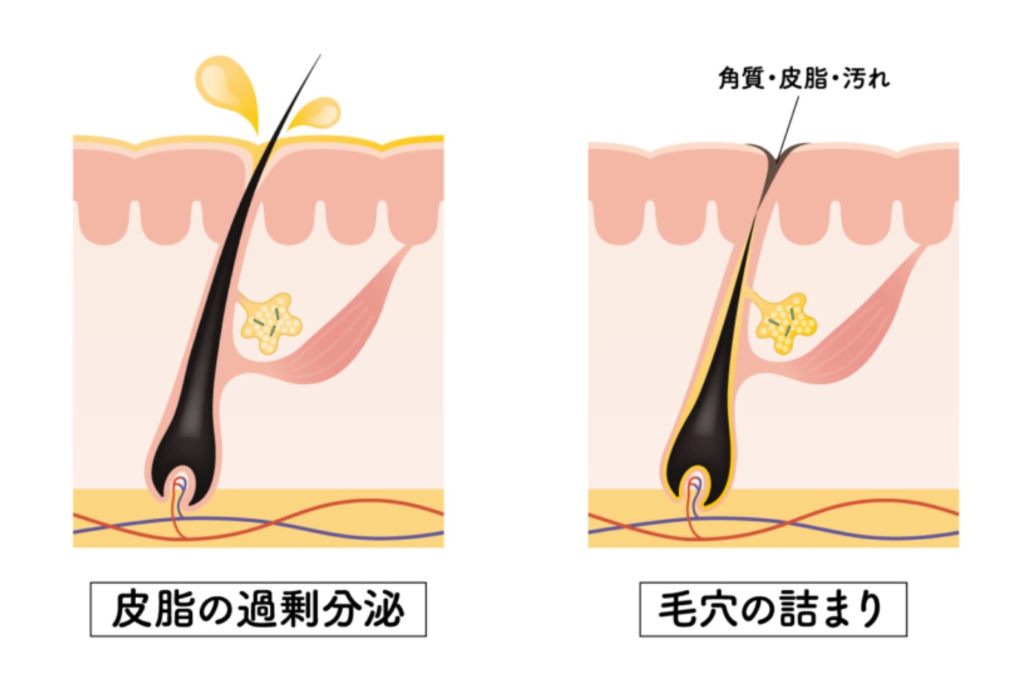 ニキビのできはじめ