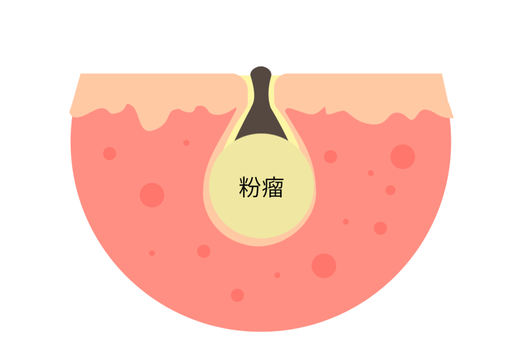 サイズが大きく繰り返す場合は粉瘤の可能性