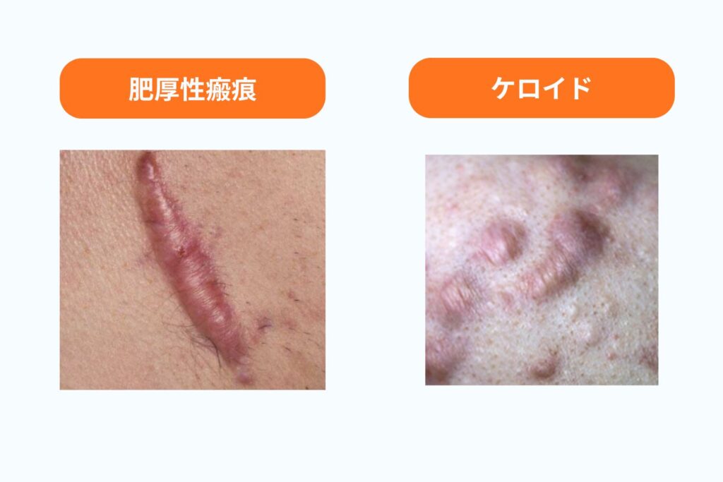 肥厚性瘢痕とケロイドの特徴