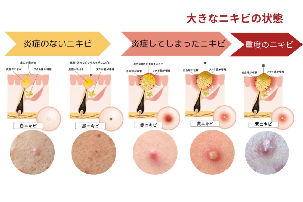 大きいニキビは段階的に悪化する